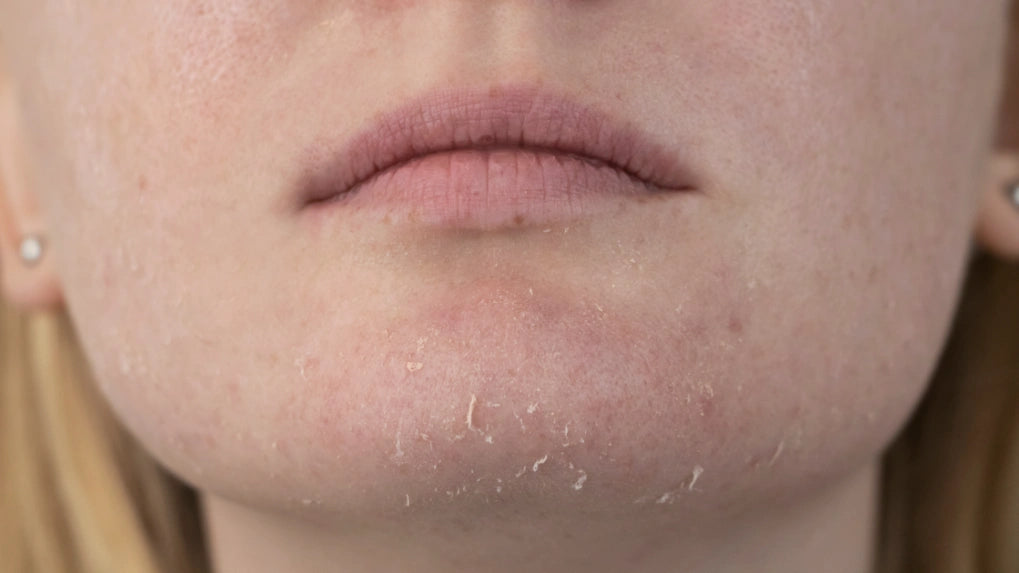 zeer droge huid verzorging