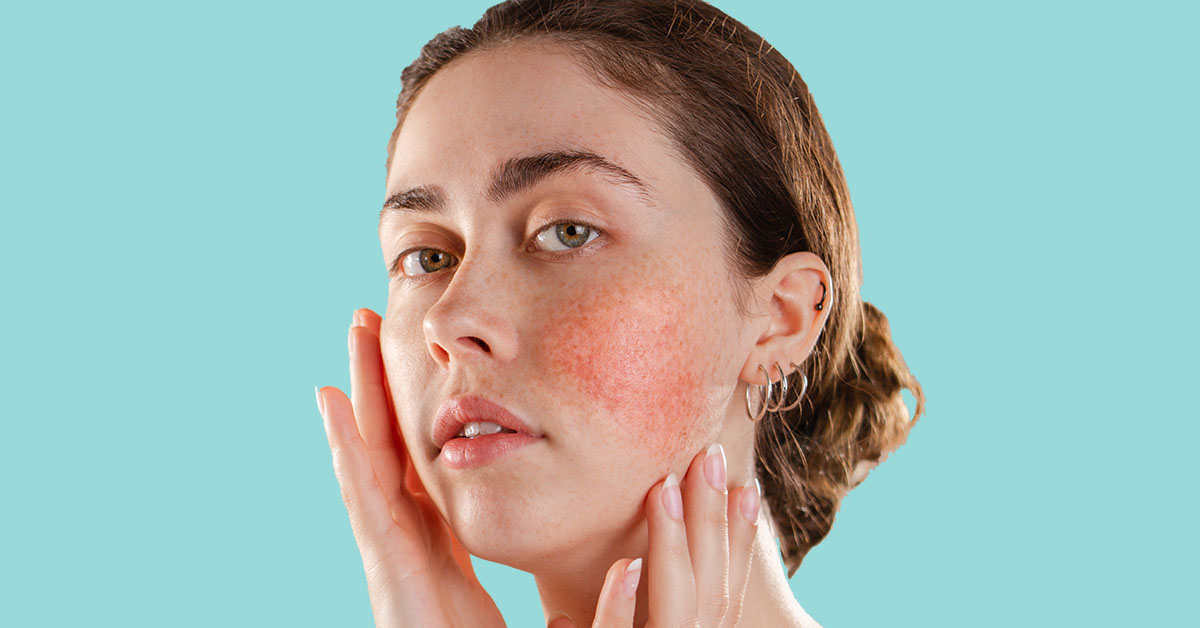 huidverzorging rosacea