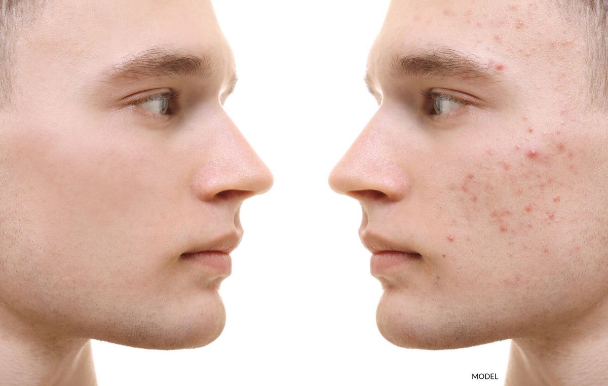 huidverzorging acne